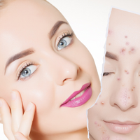 Manuka honey for acne - before and after photo of lady with acne 